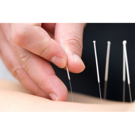 Acupunctuurt herstelt de natuurlijk balans met behulp van naaldjes